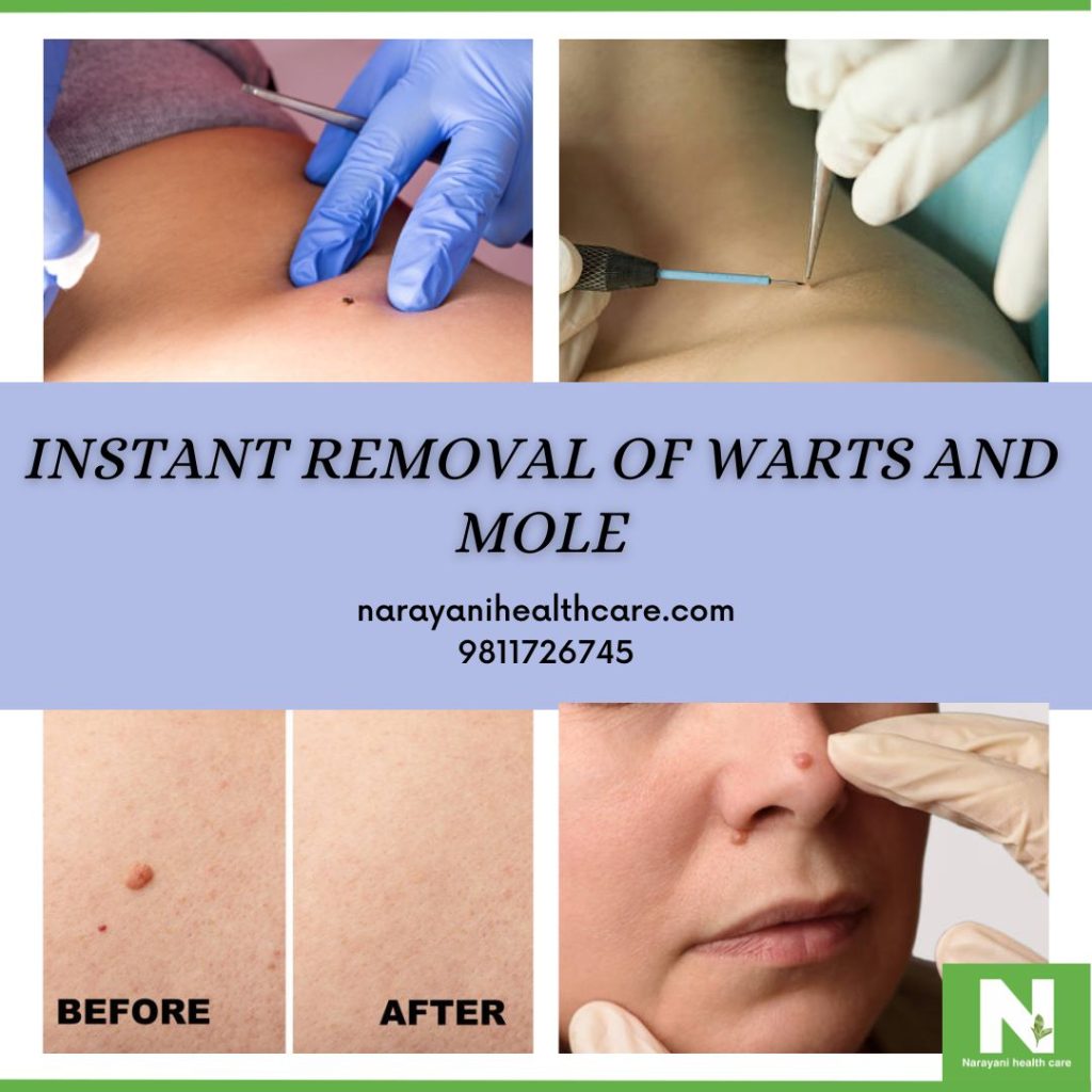 warts and mole removal