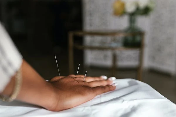Acupuncture
