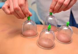 cupping therapy