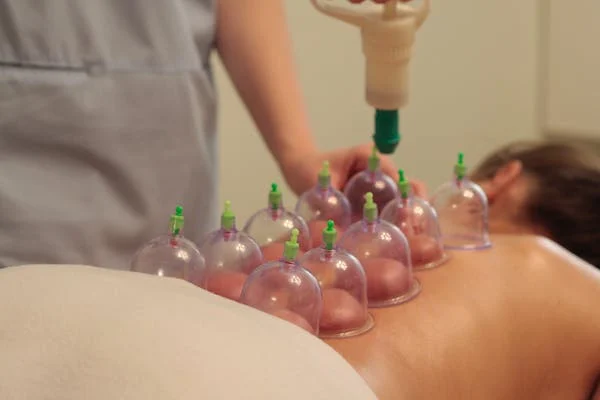 Cupping Therapy
